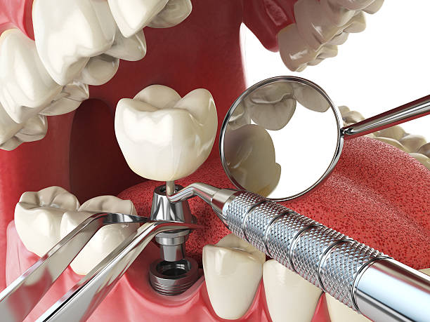 Best Knocked-Out Tooth (Avulsed Tooth) Treatment in Sibley, IA